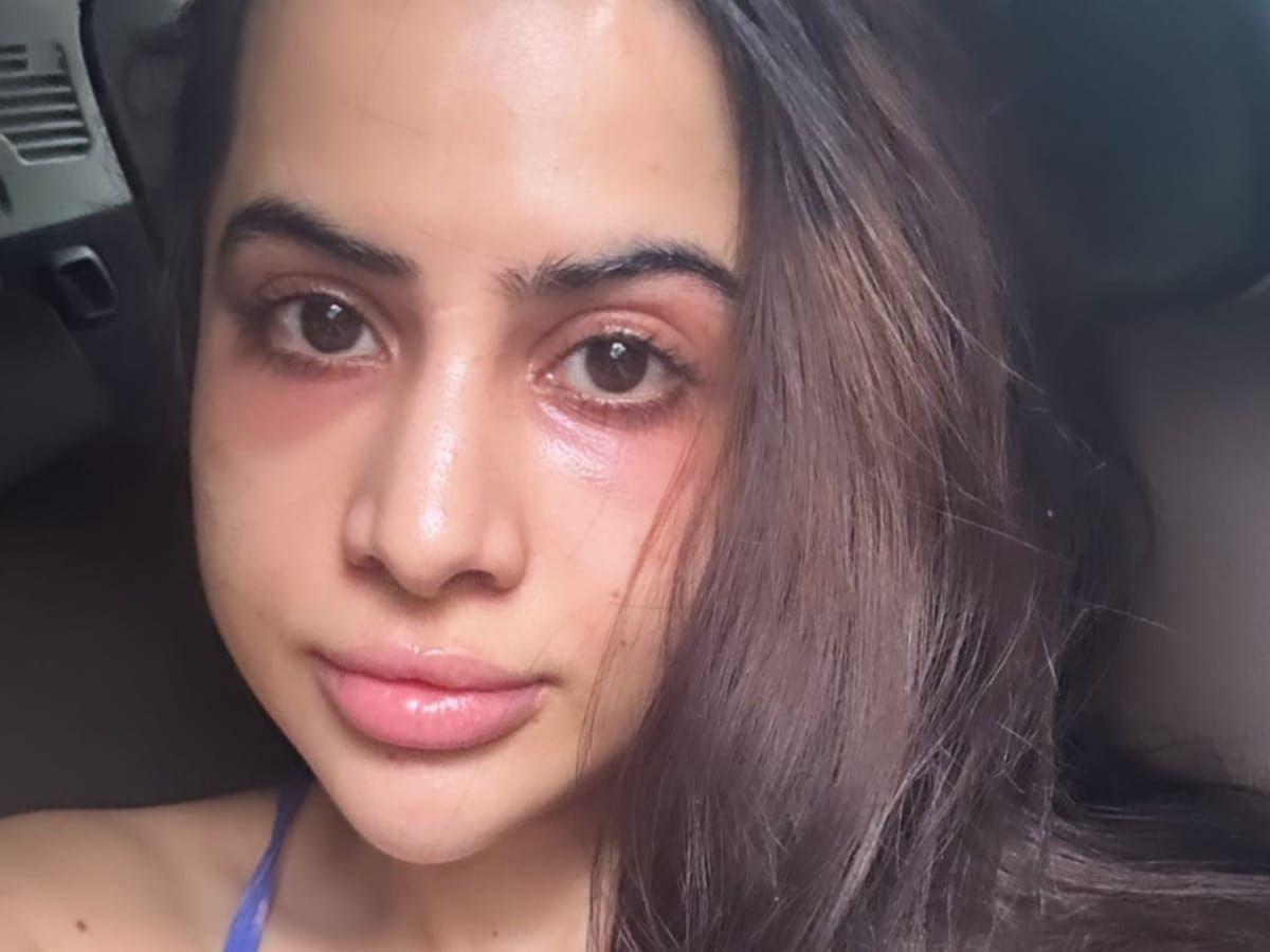 Tried under eye fillers