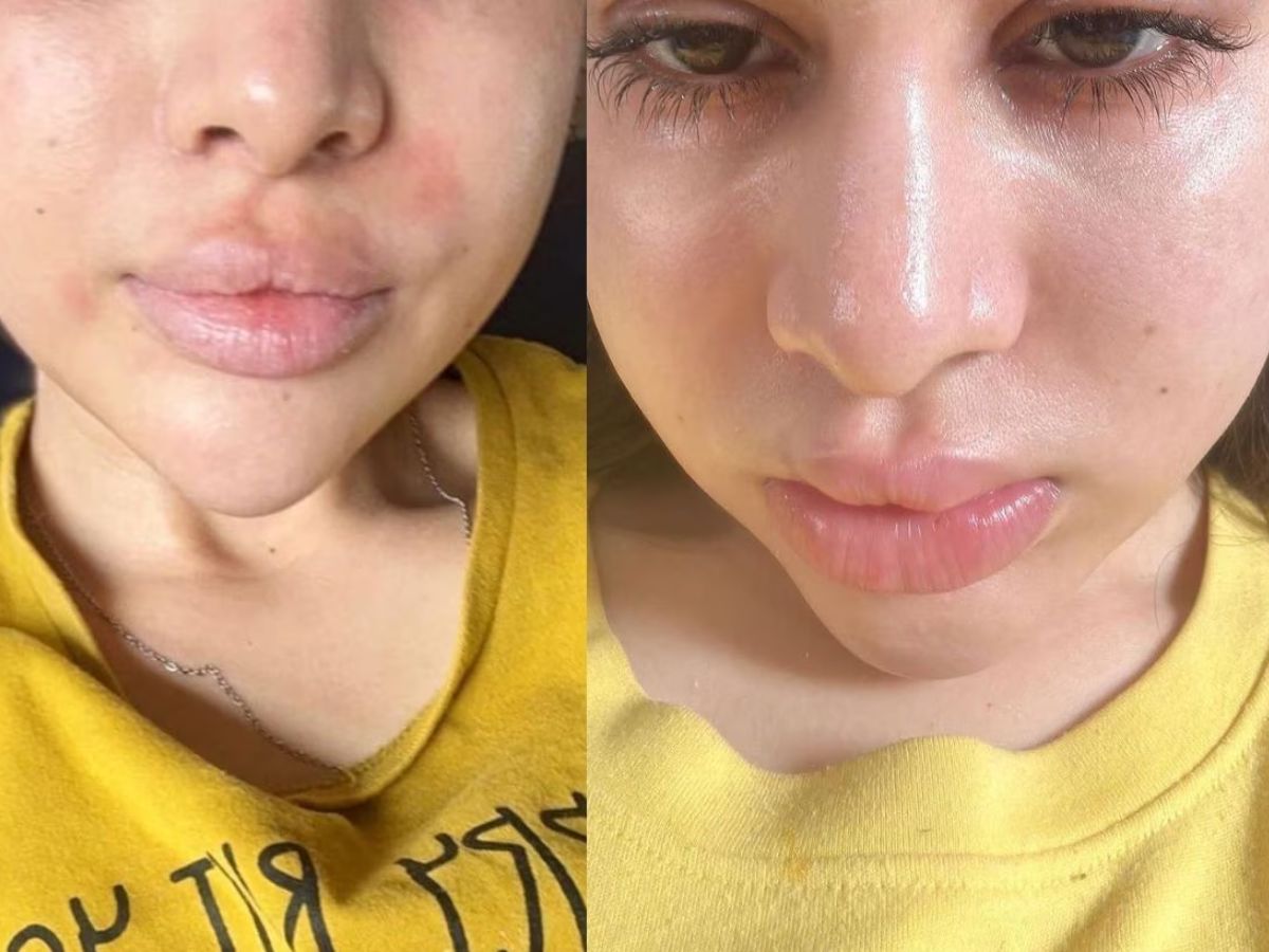 Facial swelling due to Allergies