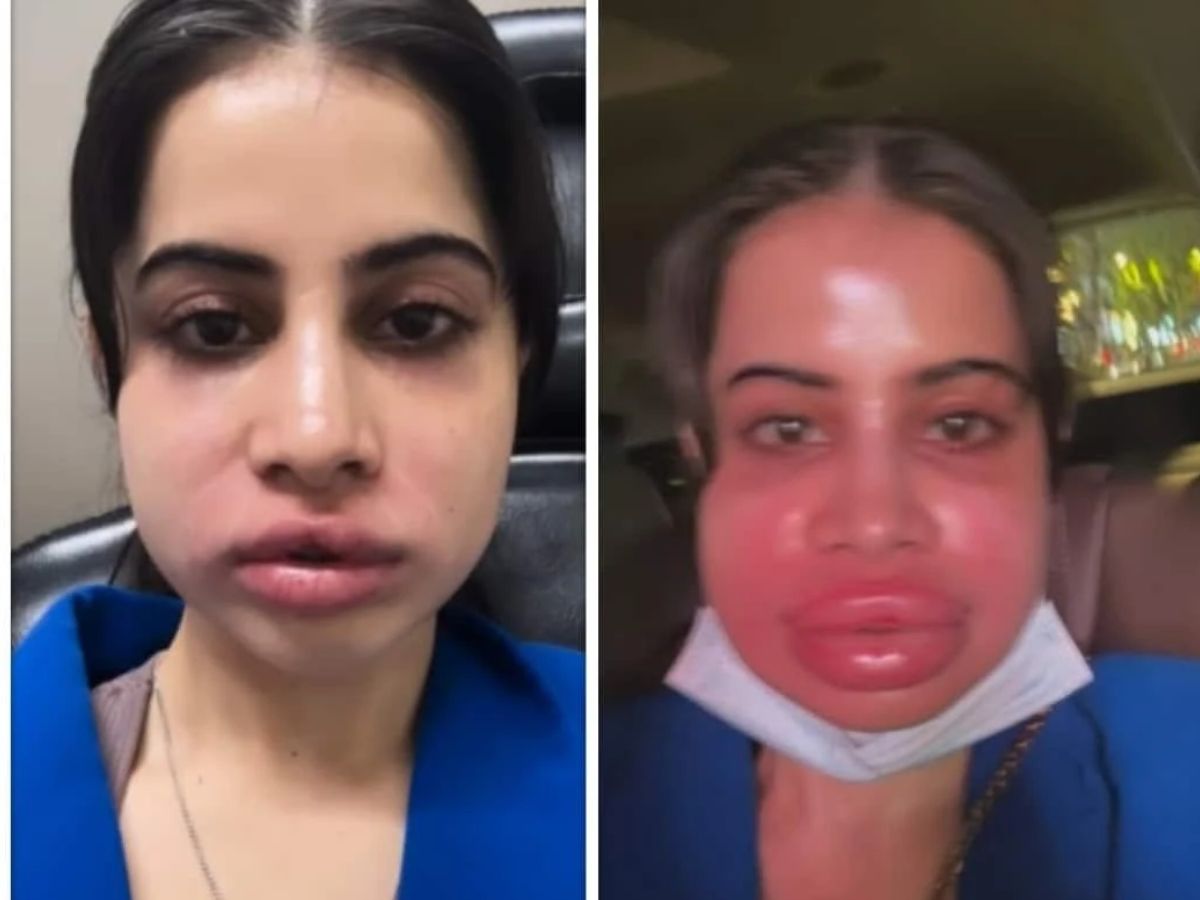 Got Filler dissolution done