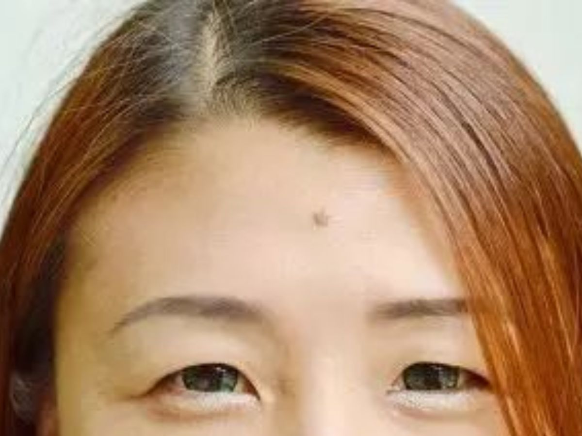 Mole On Forehead
