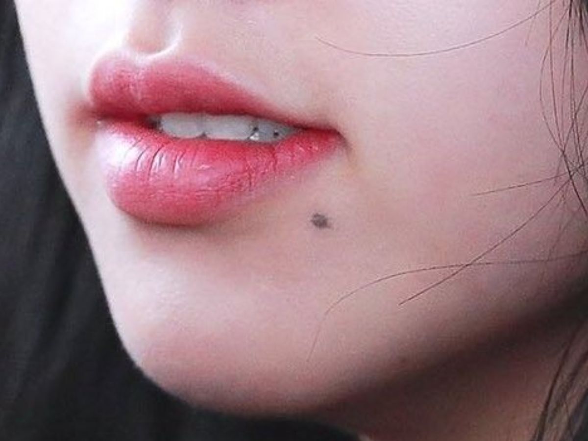 Mole On The Chin