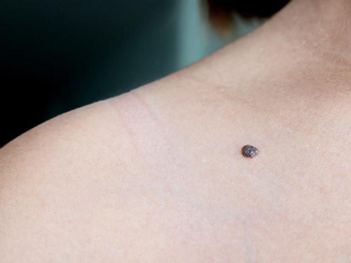 Mole On The Shoulder