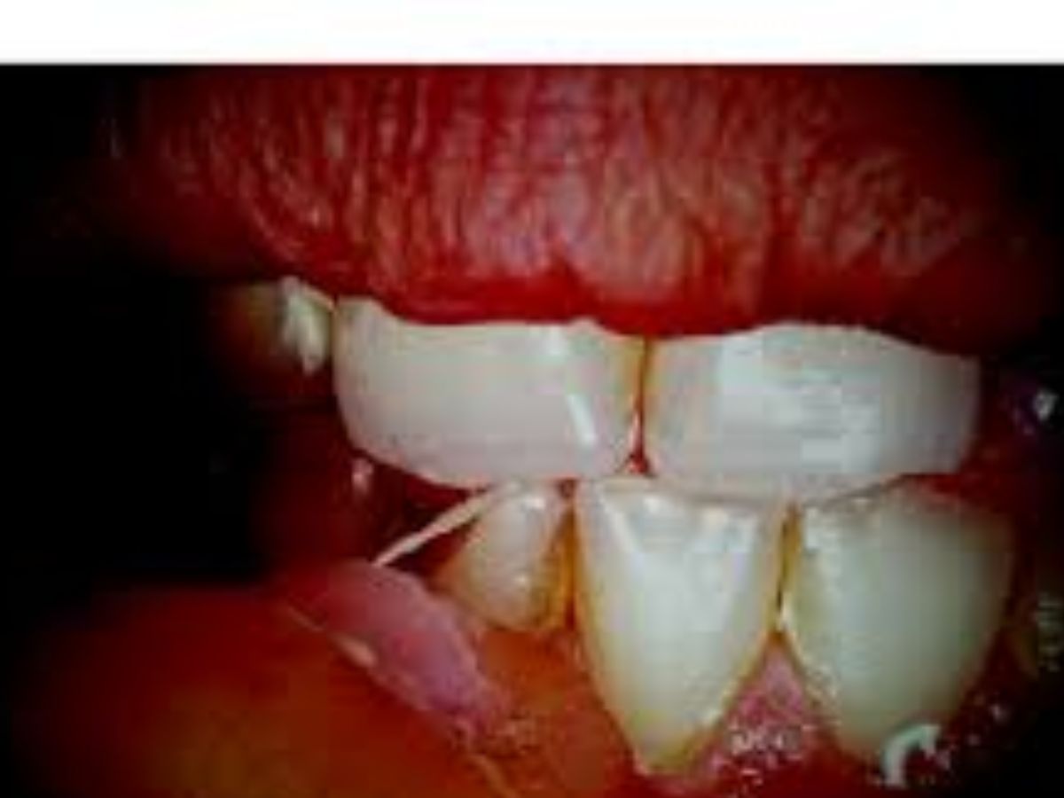 Transmission of parasites