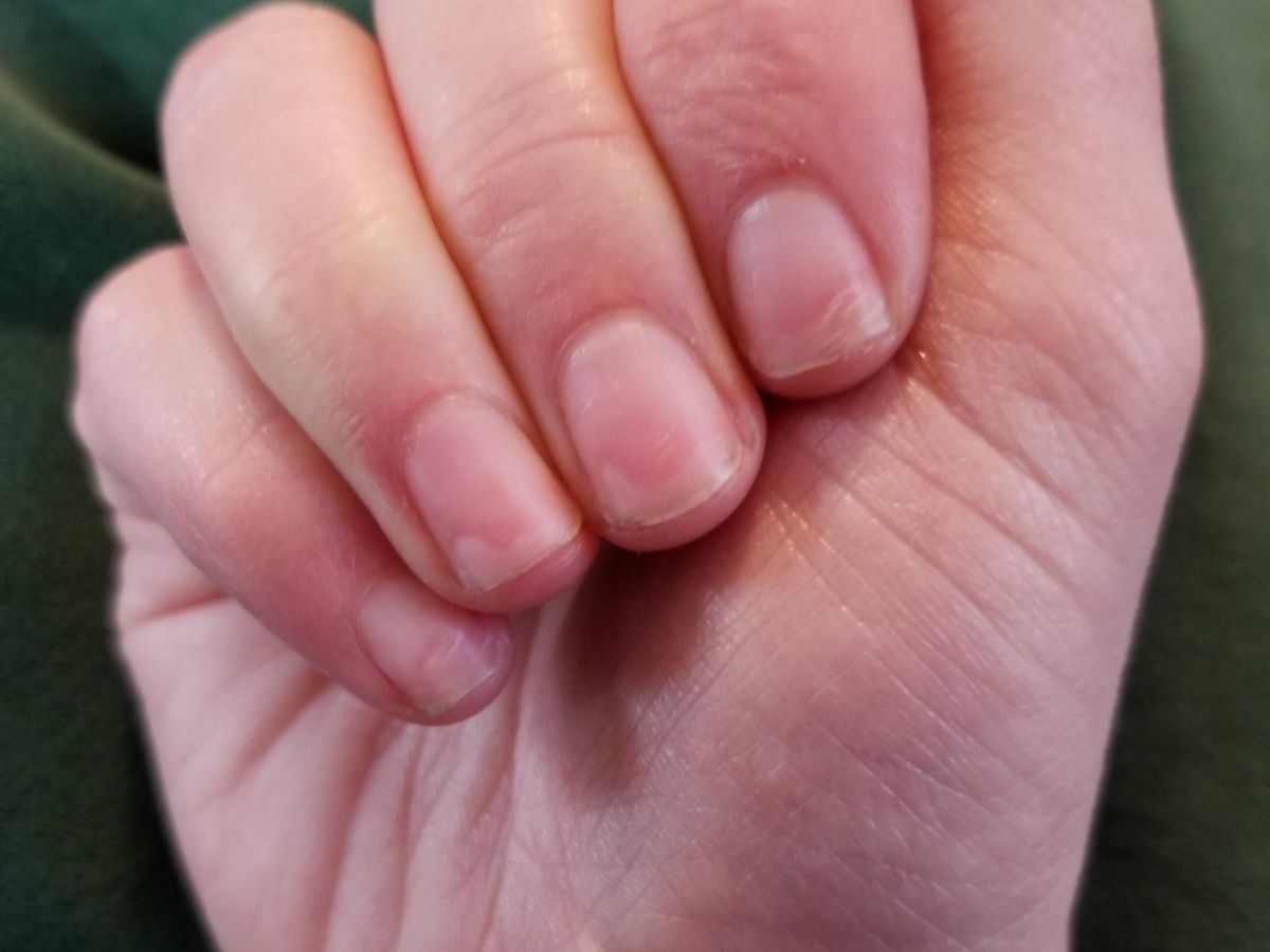 Poor nail growth and deformity