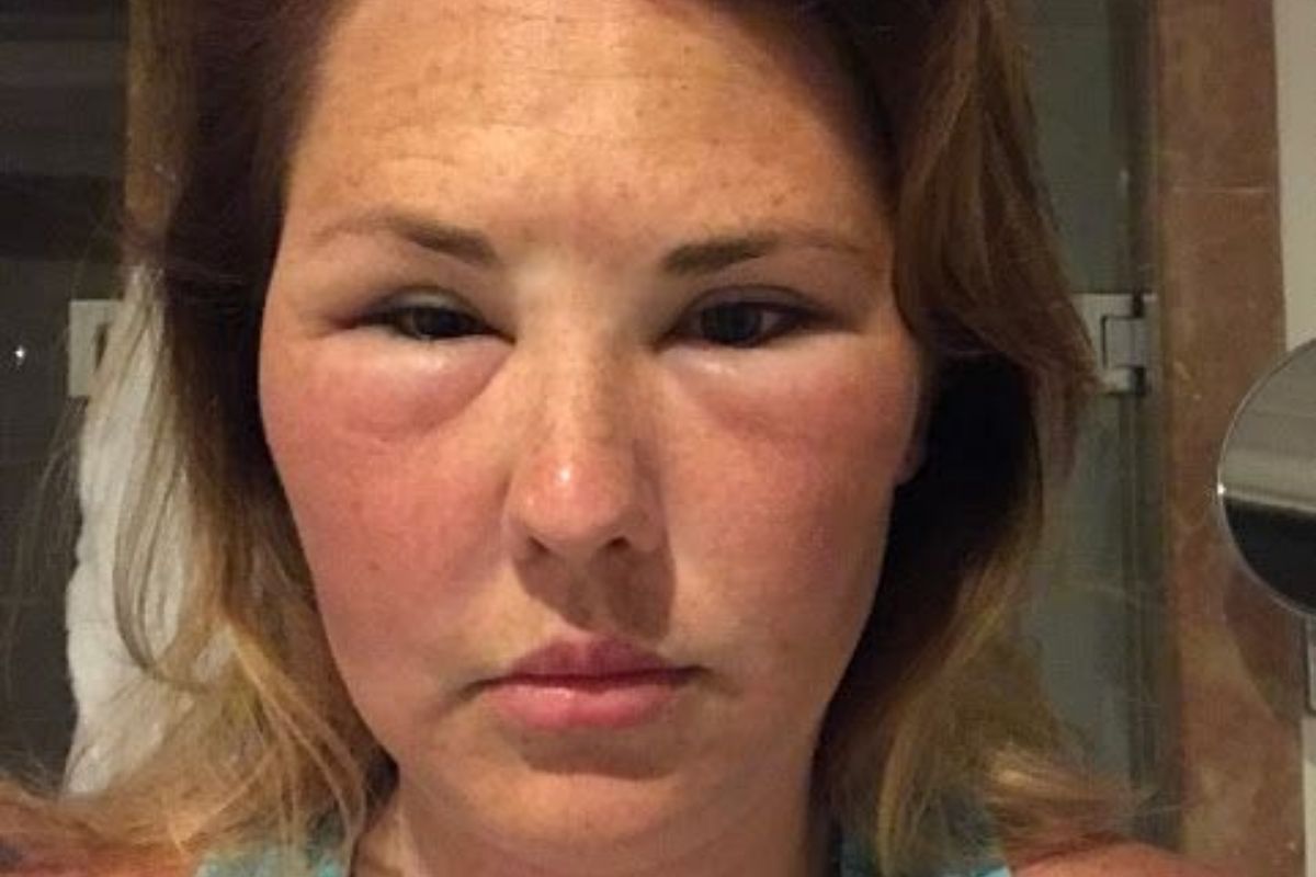 Puffiness or Swelling on Face