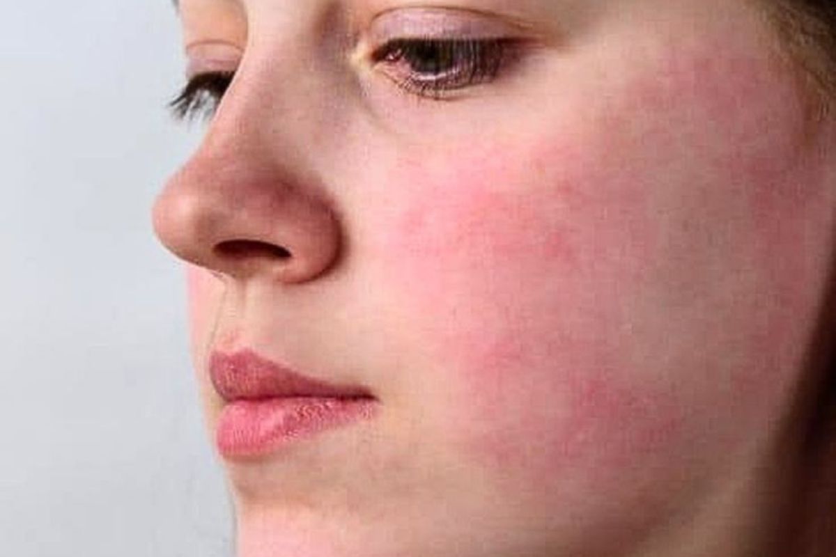 Redness or Flushed Skin