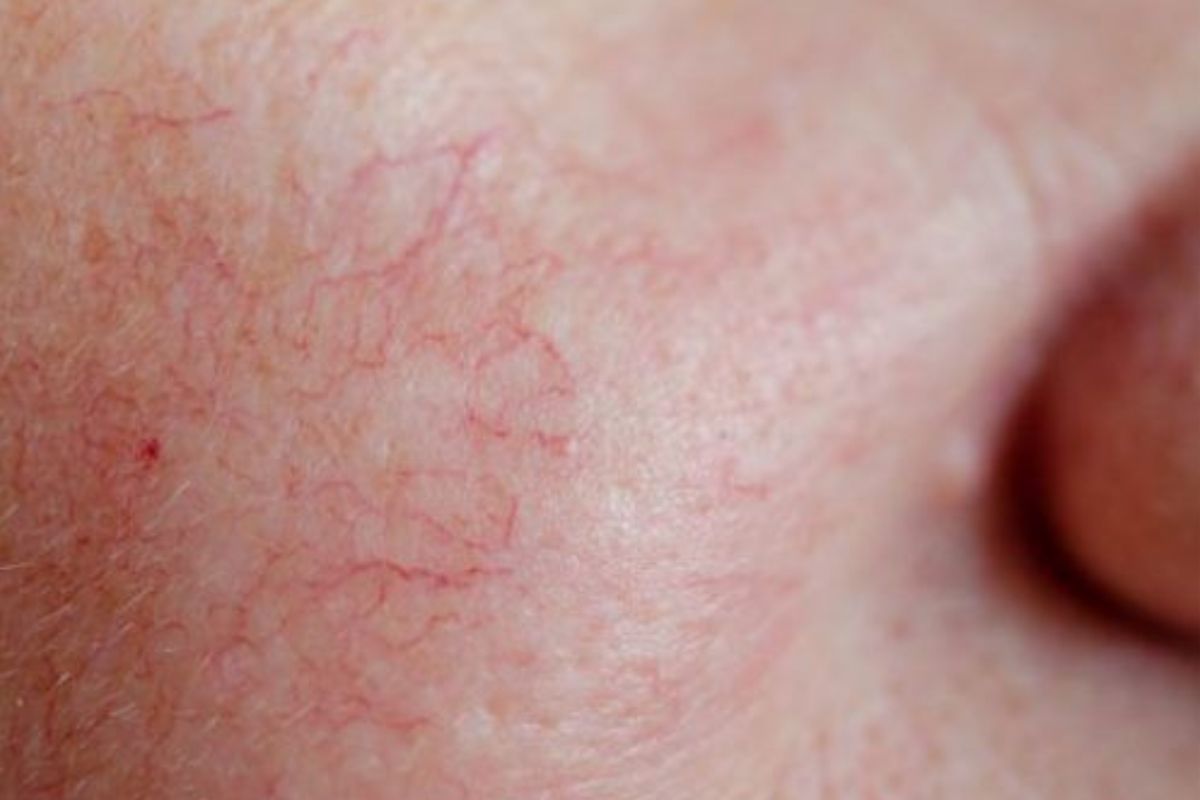 Spider Veins on Face