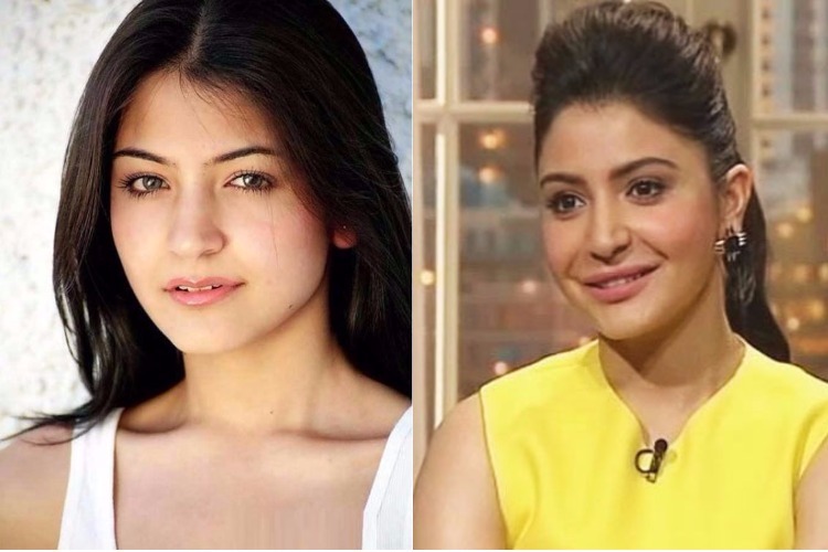 Anushka Sharma on Koffee with Karan, discussing her lip job and its aftermath.