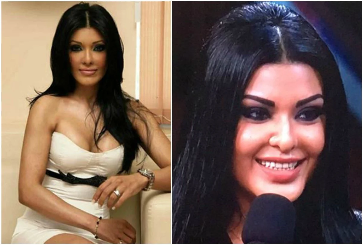 Koena Mitra discussing her nose surgery experience