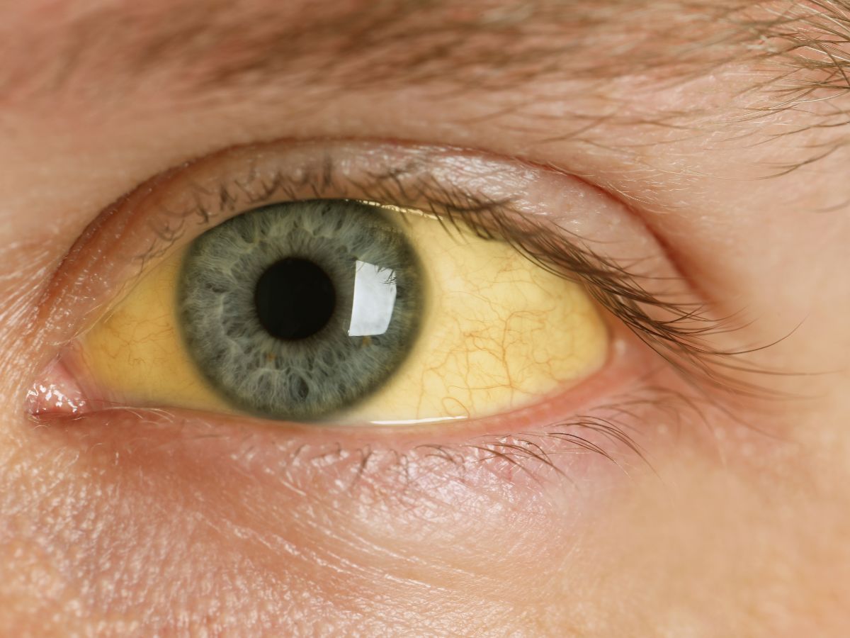 Check early signs of jaundice! Yellowing of the Skin and Eyes