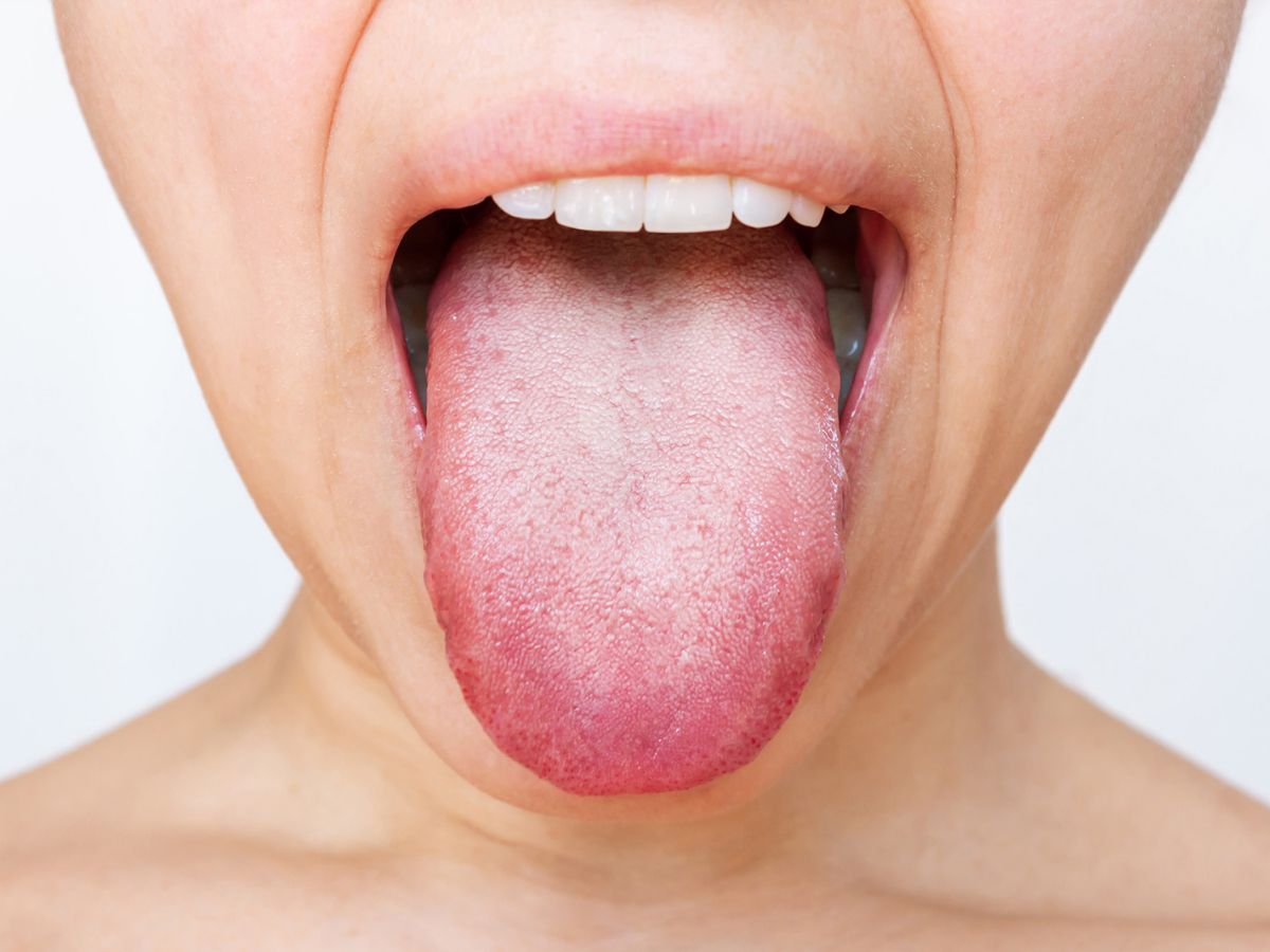 White Coating on Tongue