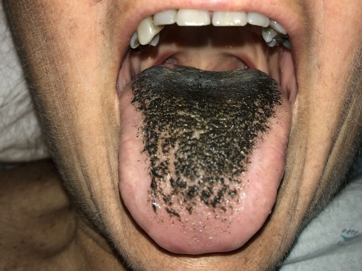 Black Hairy Tongue
