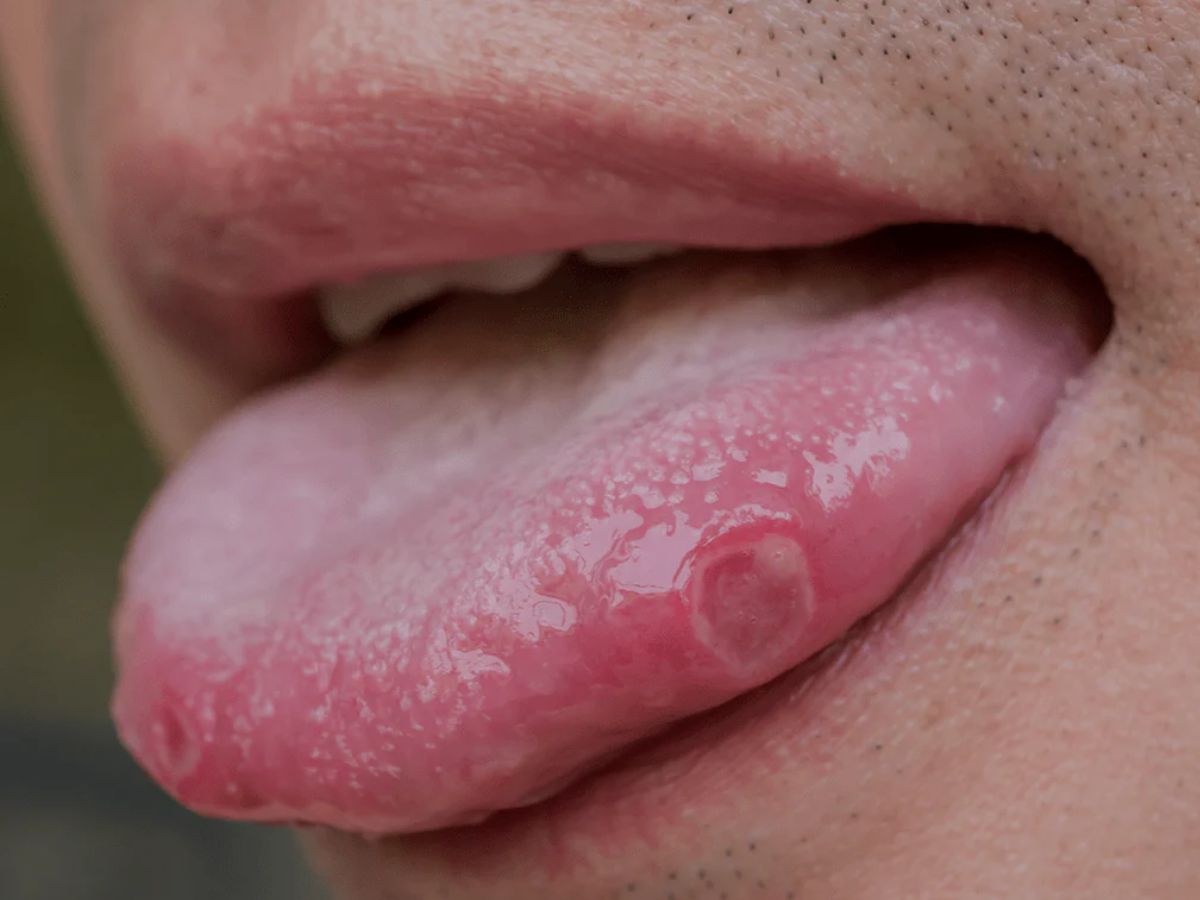 Tongue Ulcers or Sores