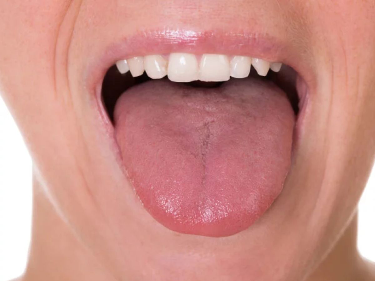Swollen or Puffy Tongue