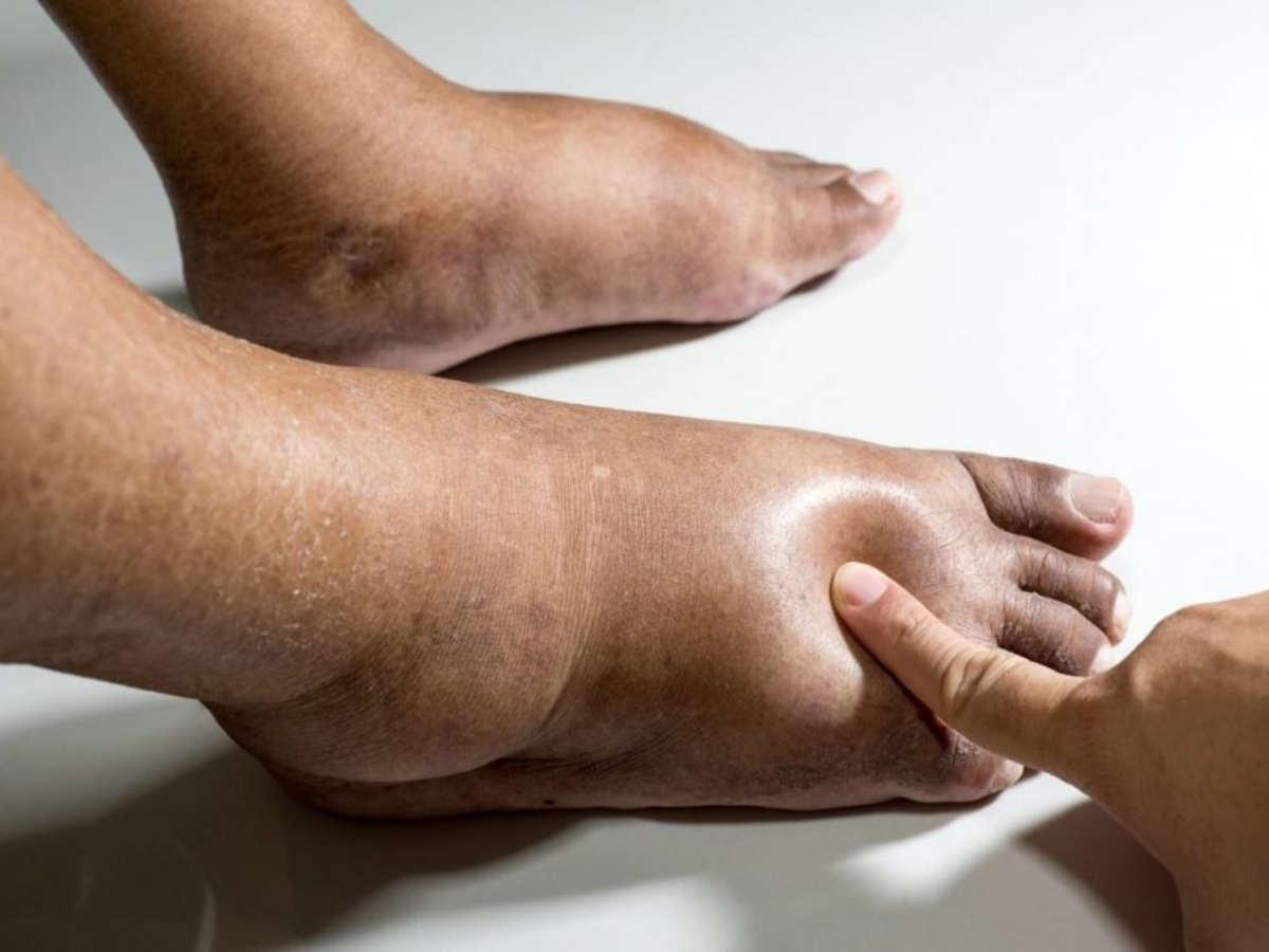 2. Reduces Inflammation and Treats Edema