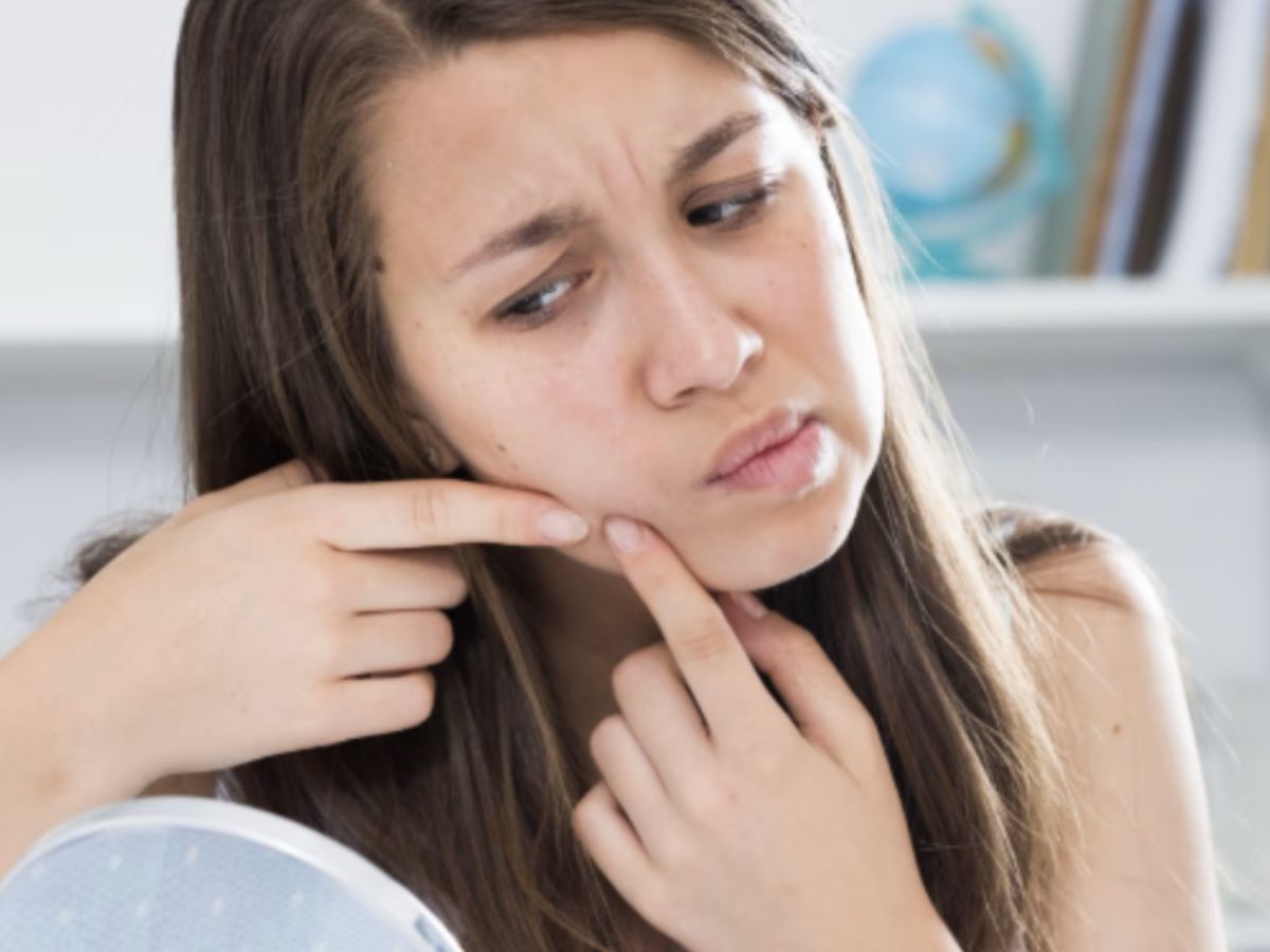 Persistent Acne and Oily Skin